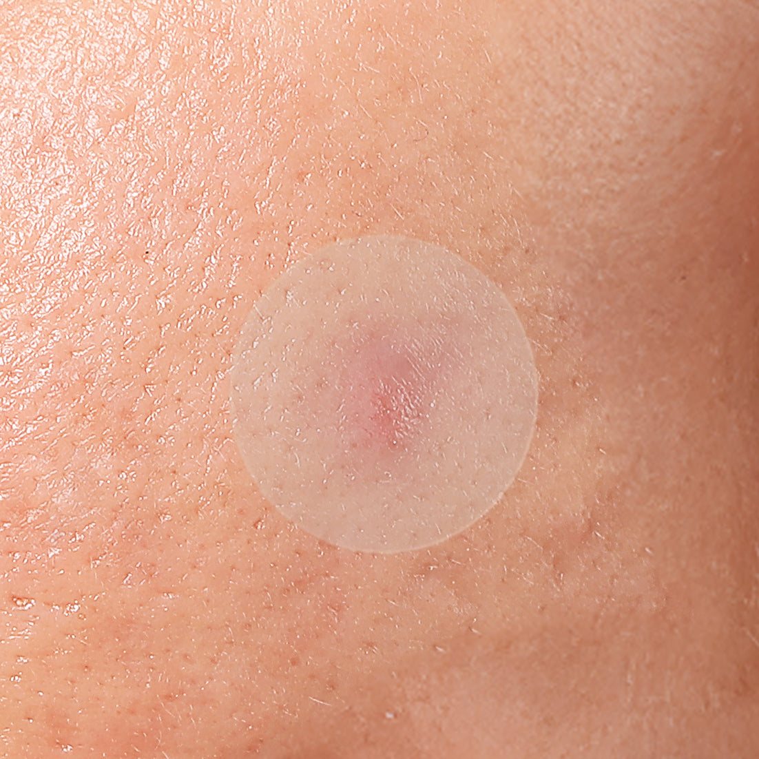 Ultra Thin Pimple Patches